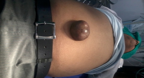 Umblical Hernia